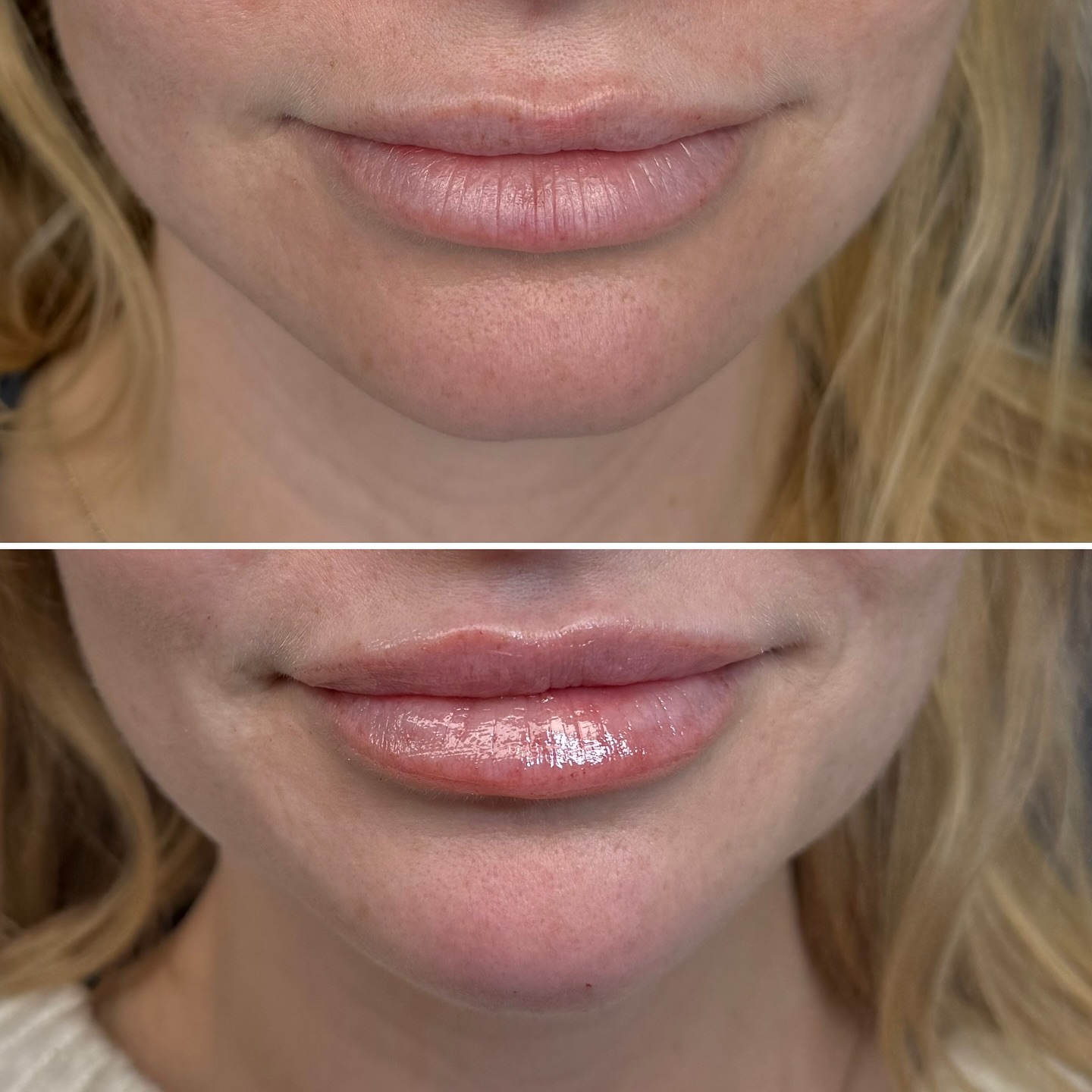 Lip filler before and after result
