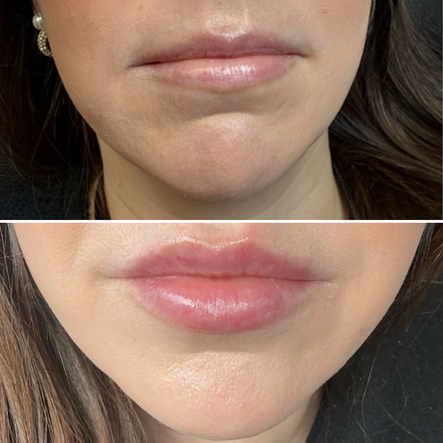 Lip filler before and after result