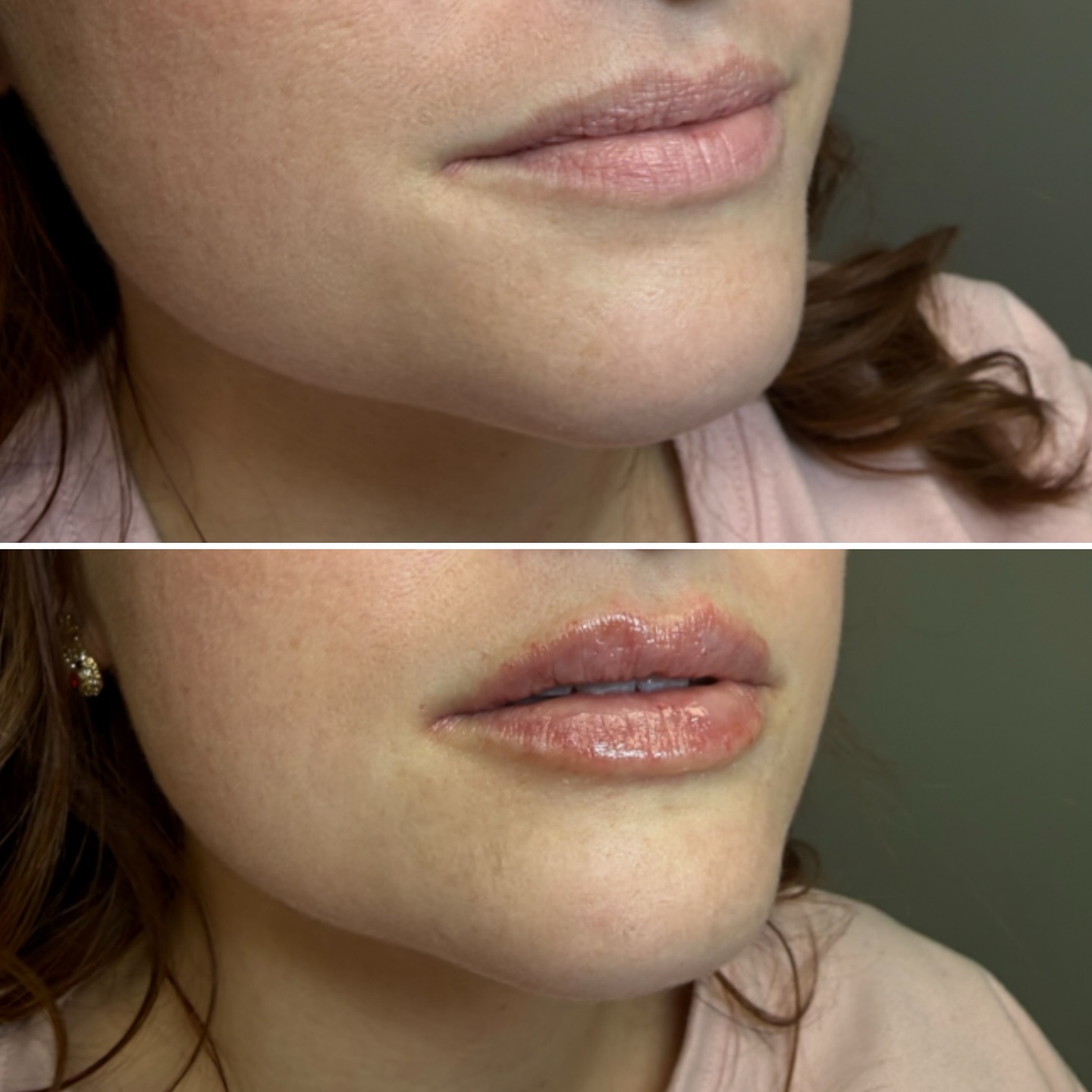 Lip filler before and after result