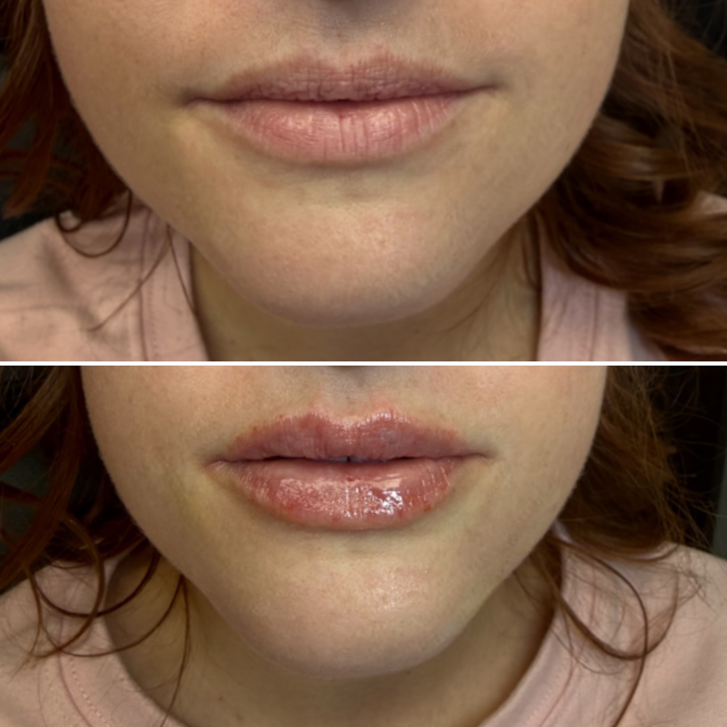 Lip filler before and after result
