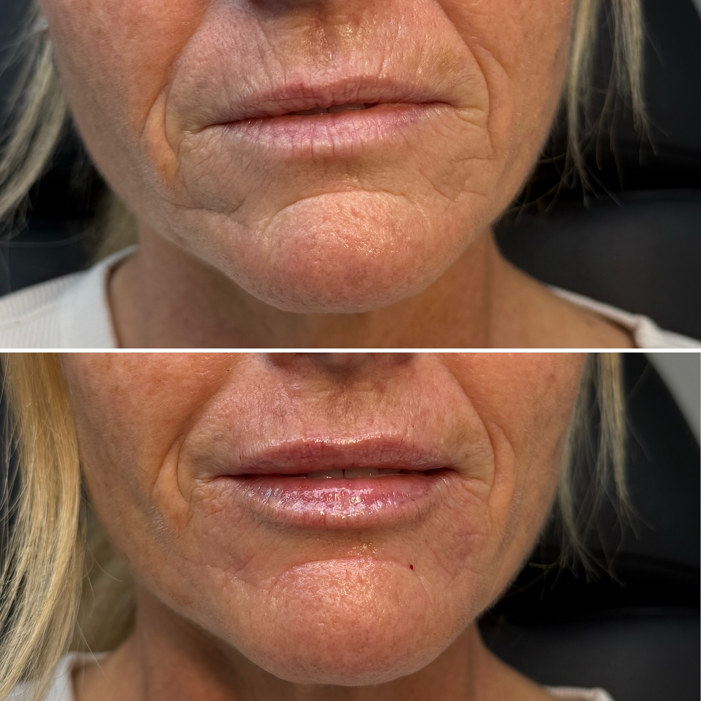 Lip filler before and after result
