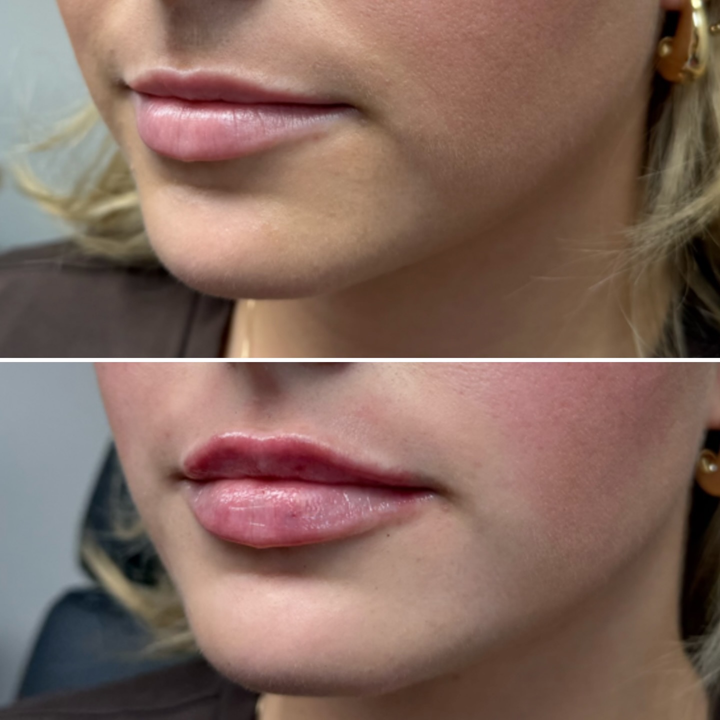 Lip filler before and after result