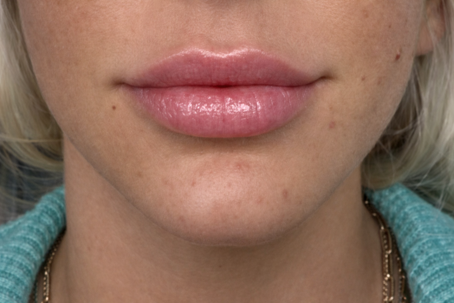 After lip filler treatment