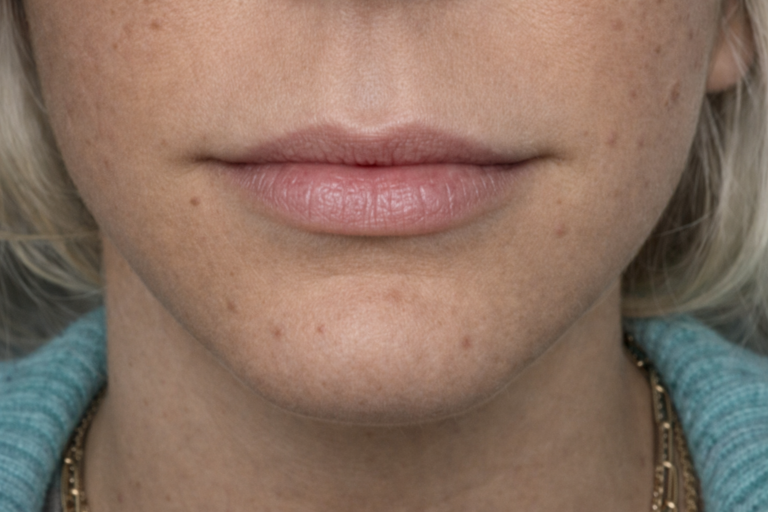 Before lip filler treatment