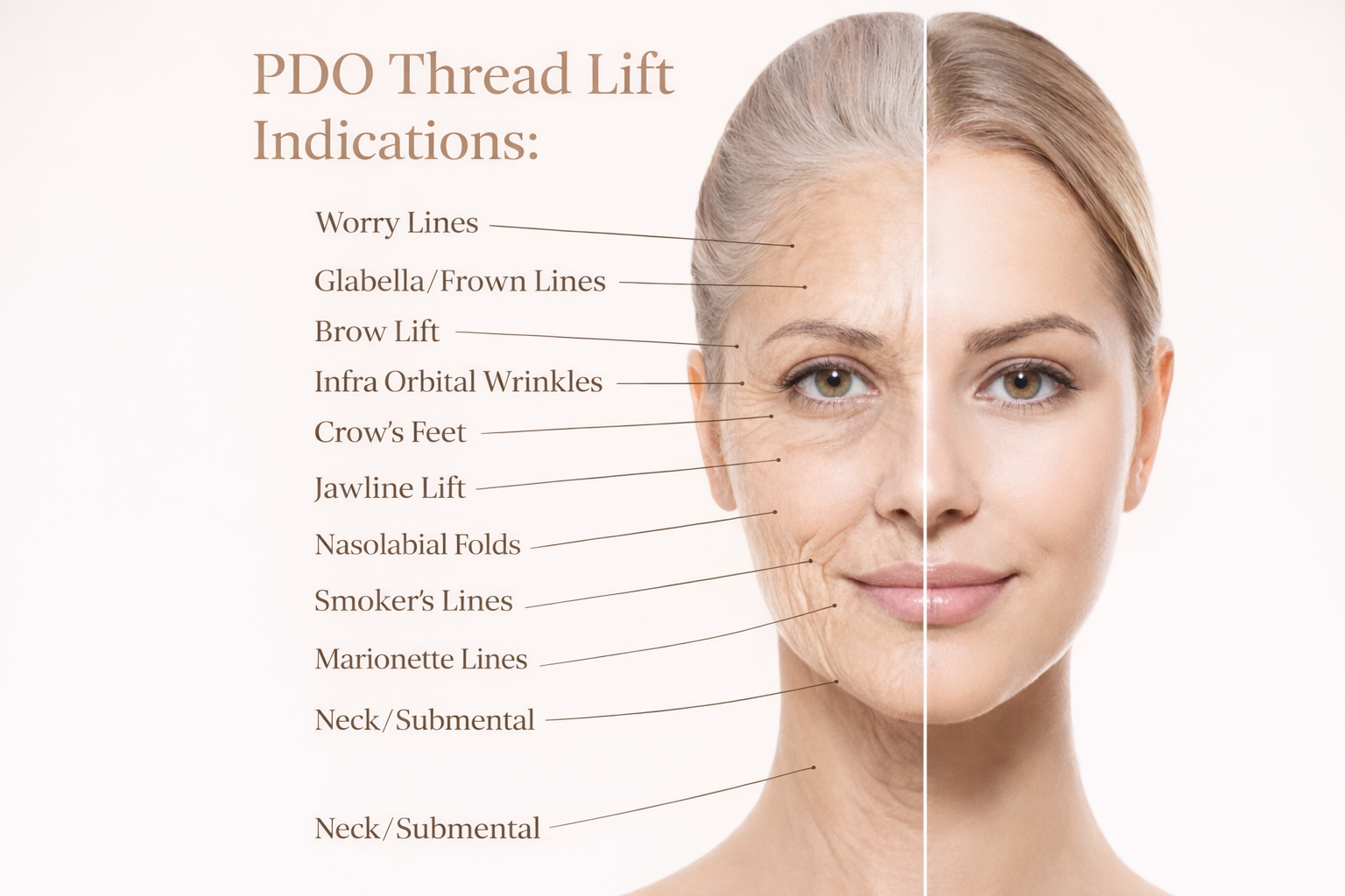 PDO Thread Lift: Face + Neck treatment at ReSculpt Aesthetics